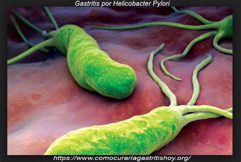Gastritis por la Bacteria Helicobacter Pylori   ¿Cómo se ...