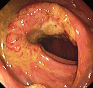 Gastroenterología » Metástasis
