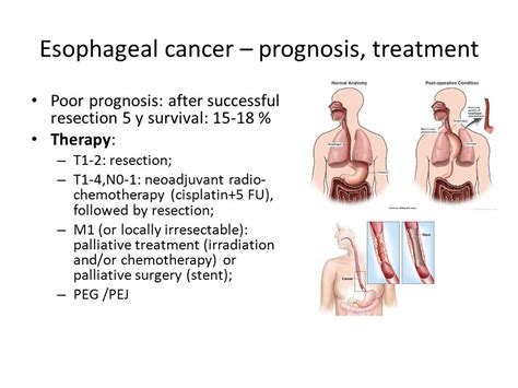 Gastrointestinal cancers   ppt video online download
