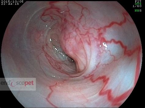 Gastrostomia endoscopica em estenose esofágica por tumor ...
