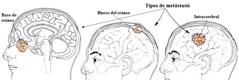 Generalidades Tumores Cerebrales – Clínica Neuros