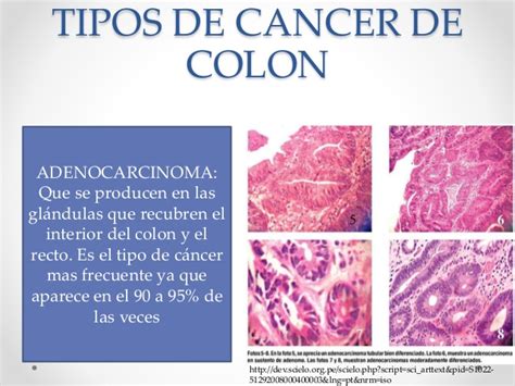genetica cancer de colon