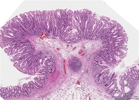 GI Pathology  Neoplastic Small Bowel and Colon   Anatomy ...