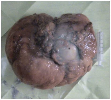 Giant primary retroperitoneal teratoma in an adult female ...