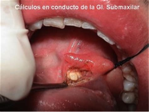 Glándulas Salivares   maxilofacialgarciavega.es