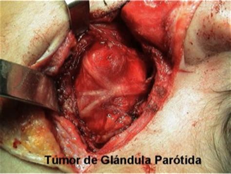 Glándulas Salivares   maxilofacialgarciavega.es