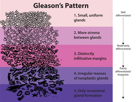 Gleason grading system   Wikipedia