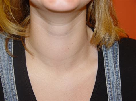 Goiter Symptoms « Ask the Doctor and be Healthy