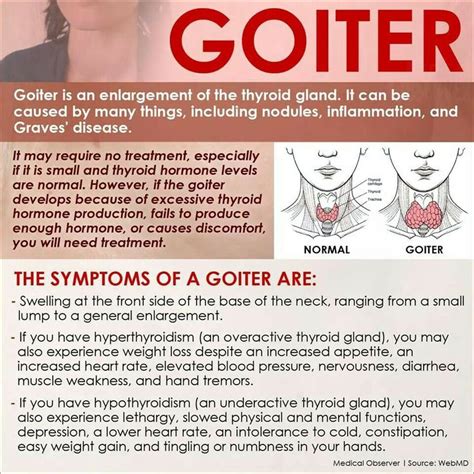 Goiter symptoms | Overcoming Grave s Disease & Hashimoto s ...