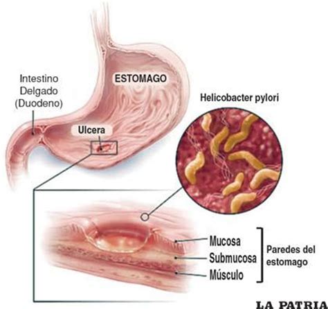 H Pylori Y Cancer De Estomago | helicobacter pylori el ...