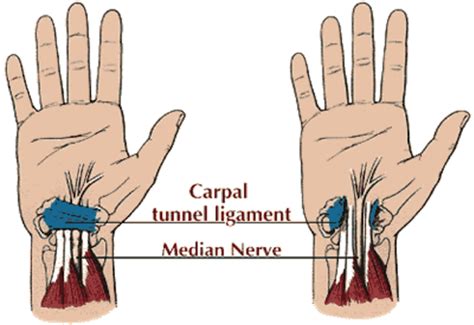 Hand Exercise In Carpal Tunnel Syndrome