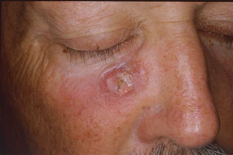 HEALTH FROM TRUSTED SOURCES: Actinic keratoses