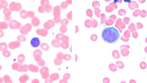 HEALTH FROM TRUSTED SOURCES: Leukemia