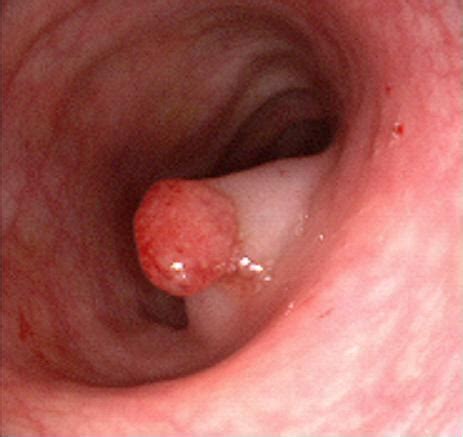 Health Symptoms | This blog deals about colon polyps ...