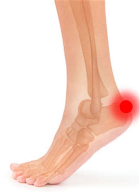 Heel Spur Symptoms   Causes of Achilles tendon Pain ...