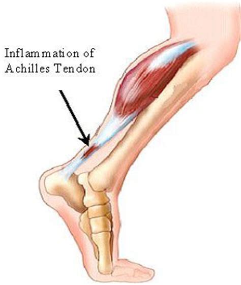 Heel Spur Symptoms   Causes of Achilles tendon Pain ...