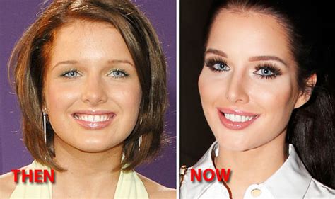 Helen Flanagan plastic surgery before and after: Doctor ...