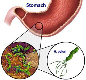 Helicobacter pylori and gastric cancer   Trans World ...