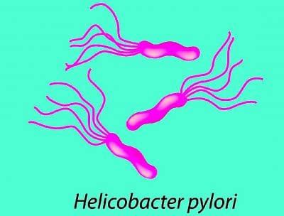 Helicobacter Pylori, gastritis, positivo, causas, síntomas ...