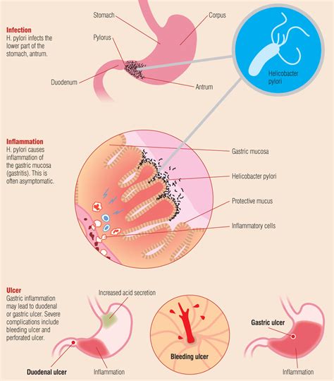 Helicobacter Pylori | www.pixshark.com   Images Galleries ...