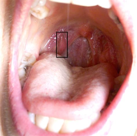 Help please   is this a swollen salivary duct? | Salivary ...