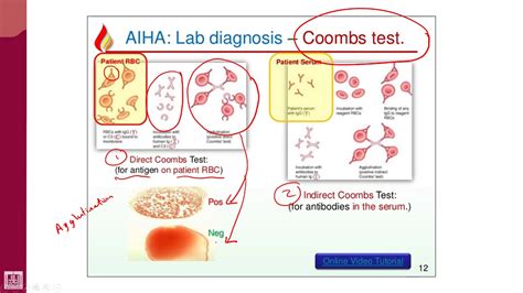 Hematology   2 | U1 L11 | Coombs test   YouTube