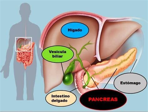 Hígado graso y pancreatitis aguda | esmigastro