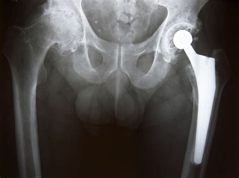 Hip Pain?? | Health Issues | Trapperman.com Forums