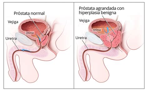 Hiperplasia benigna de próstata   Wikipedia, la ...