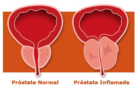 Hiperplasia de próstata Archives   Blog de Men s Health ...