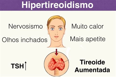 Hipertireoidismo   Sintomas e Tratamento   Tua Saúde