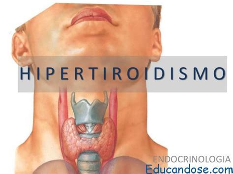 Hipertiroidismo Causas y Síntomas | ⊛ 【 Educándose En Línea