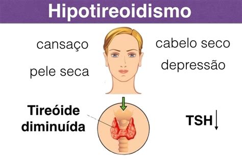 Hipotireoidismo   Sintomas e Tratamento   Tua Saúde