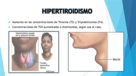 Hipotiroidismo e Hipertiroidismo