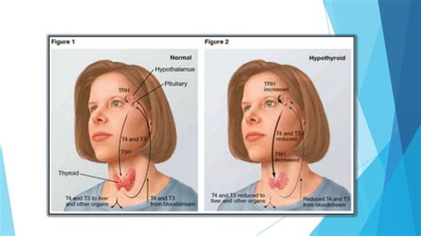 Hipotiroidismo e Hipertiroidismo