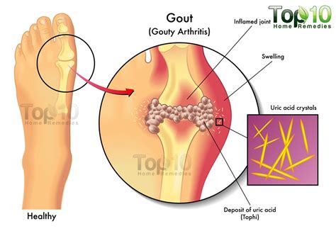 Home Remedies for Gout | Top 10 Home Remedies