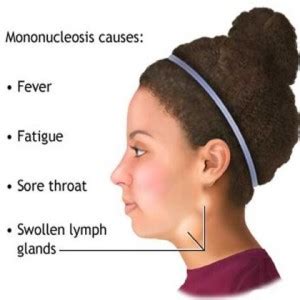 Home Remedies For Mononucleosis   Treatments & Cure For ...