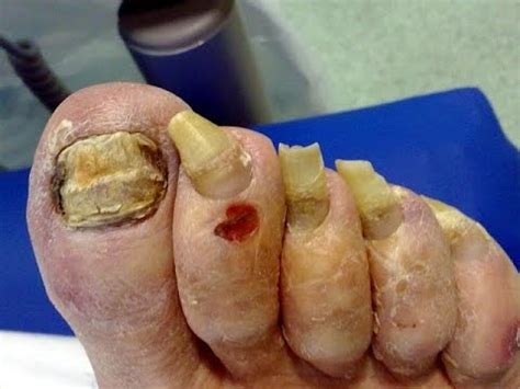 Hongos en las uñas de los pies y manos 7 tratamiento ...