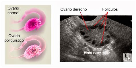 Hormonas : Síndrome del ovario poliquístico PCOS, SOP I ...