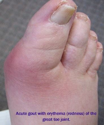 How Long Does Gout Last?   Current Health Articles