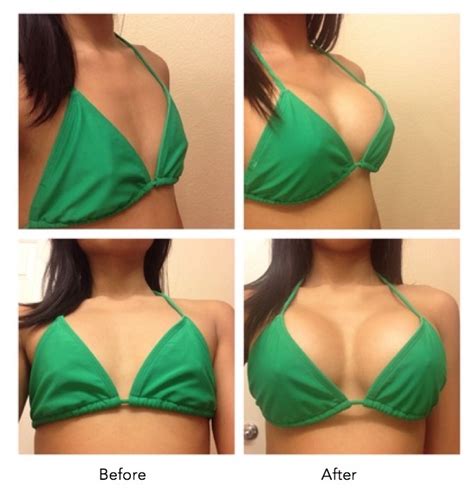 How much do Breast Implants Cost?