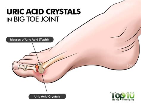 How to Control Uric Acid Levels | Top 10 Home Remedies