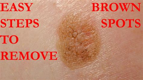 How to get rid of brown spots on skin | Home remedies ...