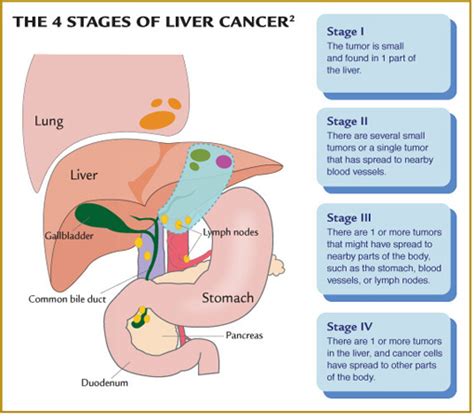 How To Get Rid of Liver Cancer