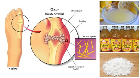 How to Lower Uric Acid Naturally   YouTube