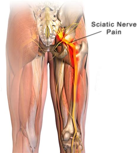 How to Relieve Sciatic Nerve Pain  Do These 9 Odd ...