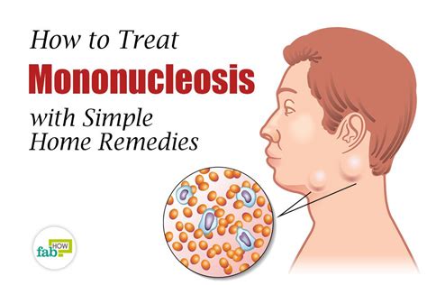 How to Treat Mononucleosis with Simple Home Remedies | Fab How