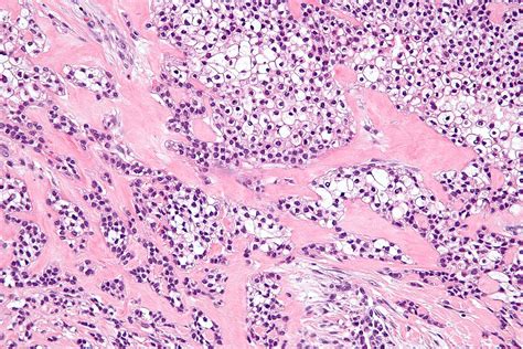 Hyalinizing clear cell carcinoma   Wikipedia
