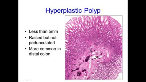 Hyperplastic Polyps: Not Always What They Seem   YouTube