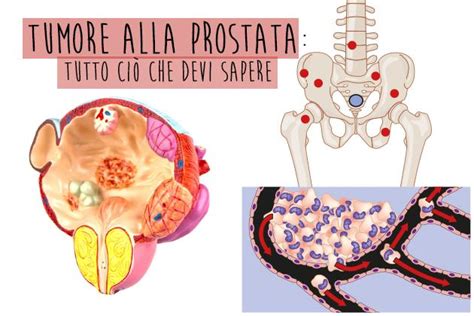 Il tumore alla prostata | Salute della prostata ...